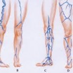 Come comportarsi dopo intervento al piede per alluce valgo e interventi metatarsali