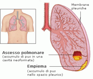 ascesso polmonare