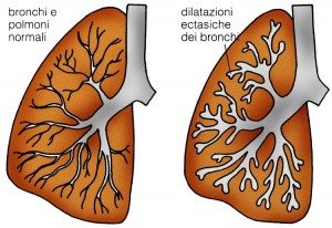 infiammazione del polmone con bronchiectasia